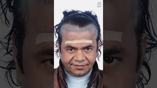 Rajpal Yadav Hair Transplant Result | Latest Fue Technique #shorts #viral #hair transplant