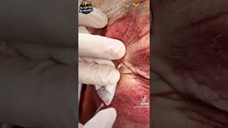 Abridged Video of 1 small cyst 🌋 removal at Las Vegas Dermatology