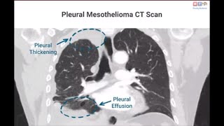 പ്ലൂറൽ മെസോതെലിയോമ {ആസ്ബറ്റോസ് മെസോതെലിയോമ അറ്റോർണി} (4)