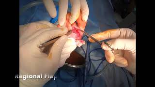 Local Flap for Chronic Open Wound of Right Foot