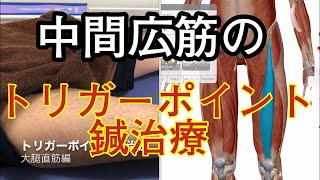 中間広筋のトリガーポイント鍼治療、大腿部の痛みに！