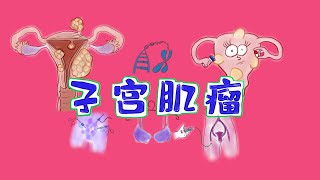 生命科学动漫|子宫肌瘤的一切：病因和发病机制+临床表现+诊断+治疗uterine fibroids: etiology  + symptoms + diagnosis + treatment