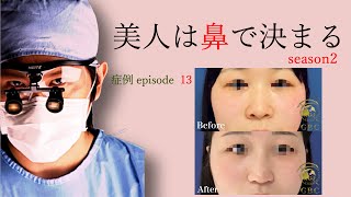 【美人は鼻で決まる】症例13：プロテーゼ・鼻尖形成・鼻翼縮小・鼻尖部軟骨移植。小鼻のハリがつよかったので肉厚減幅術で小さくしました。鼻整形年間2,000件の杉崎裕斗がわかりやすく解説。