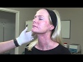 Skin Tightening Without Surgery - Profhilo - Dr Ian Strawford at Skin Excellence Clinics