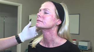 Skin Tightening Without Surgery  Profhilo  Dr Ian Strawford at Skin Excellence Clinics