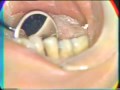 Endodontic Surgery: Hemisection