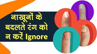 नाखूनों या Nails के रंग बदलने का क्या मतलब है? | Causes of Nail Discoloration