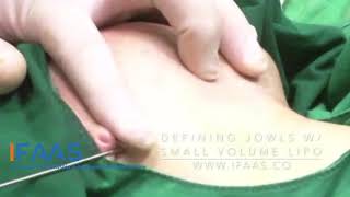 IFAAS Exclusive Technique - Defining Jawlines with Small Volume Liposuction under Local Anesthesia