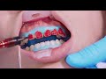 what to expect with opalescence boost professional teeth whitening