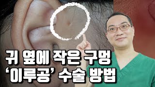 [좋은문화병원] 귀 옆에 작은 구멍 '이루공' 수술 방법