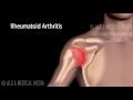 shoulder arthritis narrated animation.