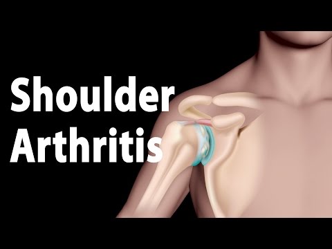 Shoulder Arthritis Narrated Animation. Shoulder Arthritis Narrated Animation.