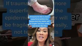 BIG WATER BLISTER! Derm Lessons with Dr Pimple Popper