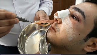 Removing nose mesh, 2 days after rhinoplasty surgery  | خارج کردن مش بینی 2 روز بعد از عمل جراحی