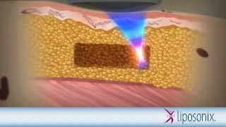 Liposonix Mechanism of Action Animation