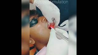 Laser treatment for Oral submucous fibrosis