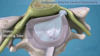 Percutaneous Endoscopic Discectomy in Case of Cervical Disc Prolapse