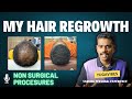 How i regrow my hair without hair transplant| Hair loss in Tamil #hair #haircare #transformation