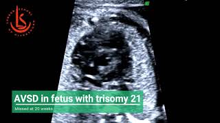 AVSD for fetus with Down's syndrome missed at 20 weeks scan