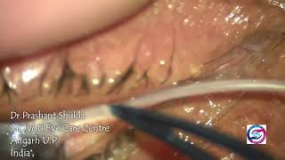 MINI MONOKA STENT FOR RECURRENT PUNCTAL STENOSIS #eyedoctors #eyes #cataractsurgeon