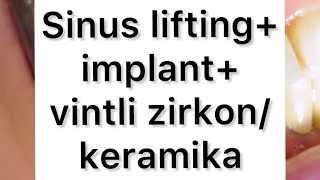 Sinus lifting, implant, vintli zirkon keramika