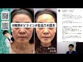 藤巻先生解説　糸リフトだけでどこまで若返れる 【糸リフト】【若返り】ver.2