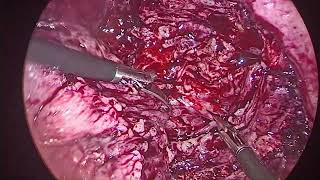 Lap adenomyomectomy with UALand temporary ovarian artery ligature recon using flap method