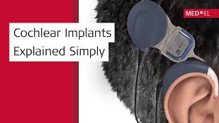 How Do Cochlear Implants Work? | SYNCHRONY & SONNET 3