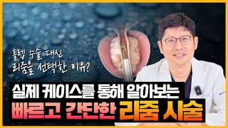 실제 케이스를 통해 알아보는 빠르고 간단한 '리줌 시술'