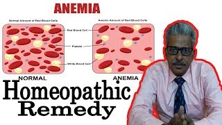 Anemia - Discussion and Treatment in Homeopathy by Dr. P.S Tiwari Anemia - Discussion and Treatment in Homeopathy by Dr. P.S Tiwari