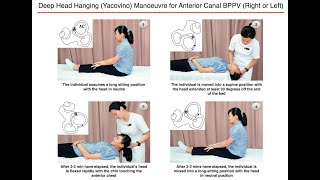 Deep Head Hanging (Yacovino) Manoeuvre for Anterior Canal BPPV (Right or Left)