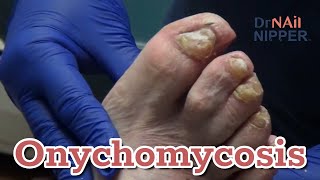 Throwback - Doc Returns, Thick Toenails, Onychomycosis