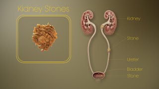 වකුගඩු ගල් ඉවත් කිරීම / How to remove kidney stone