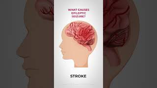 What causes epileptic seizures?