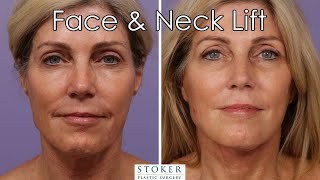 Facelift Los Angeles: Dr. Stoker Reveals Natural Results from Face and Neck Lift Surgery