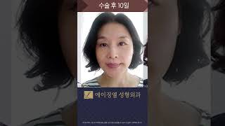 안면거상 10일 후 👨‍⚕️서울대 20년 경력 #김수철원장 #에이징엘