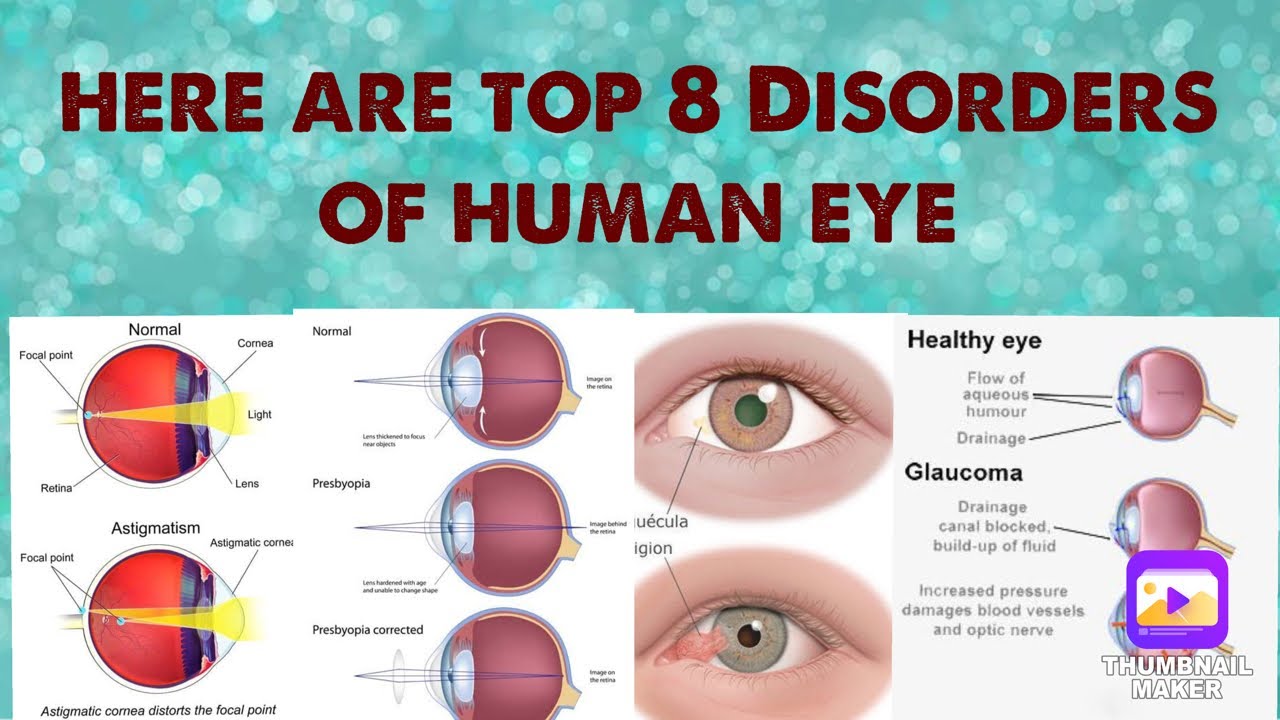 Disorders Of Human Eye - YouTube