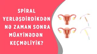 SPİRAL YERLƏŞDİKDƏN SONRA NƏ ZAMAN ARALIĞINDA GİNEKOLOJİ MÜAYİNƏDƏN KEÇMƏLİYİK?