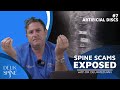 Artificial Disc Replacement Complications. (Ep.7 Spine Scams)