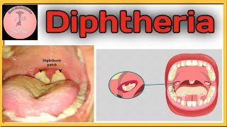 Diphtheria - Human Health and Disease | Class 12 Biology