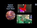 Hybrid atrial fibrillation ablation