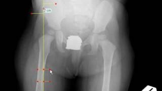 TraumaCad - Articulo-trochanteric Distance