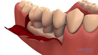 Flap Surgery/Pocket Reduction Surgery
