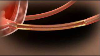 Video Demo of the Allium Ureteral Stent (URS)