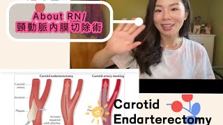 About RN/ CEA 頸動脈內膜切除術分享