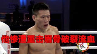 俄拳击冠军犀利重击令中国小伙眉骨破裂流血The Russian boxing champion's heavy blow broke opponent's eyebrow bone and bled