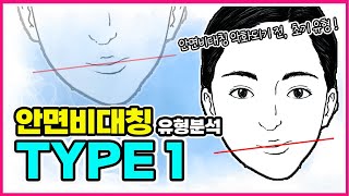 안면비대칭 타입1, 안면비대칭 TYPE1 자세히 알려드립니다. (안면비대칭유형 정리)