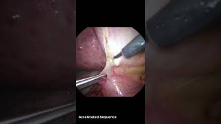 Lysis of Adhesions during Laparoscopic Subtotal Fenestrating Cholecystectomy in a Cirrhotic Patient