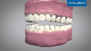 Descubre cómo funciona la Reconstrucción Dental en Vitaldent