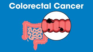 Colorectal Cancer: Are You at Risk? | Munson Minutes